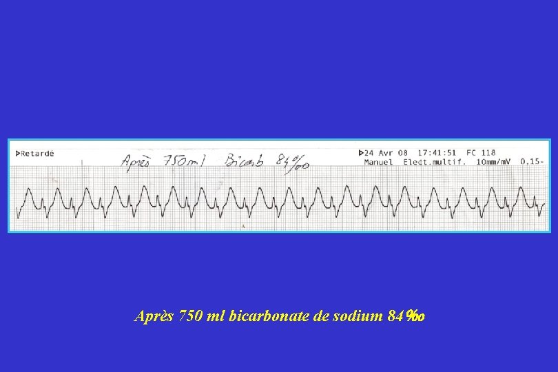 Après 750 ml bicarbonate de sodium 84‰ 