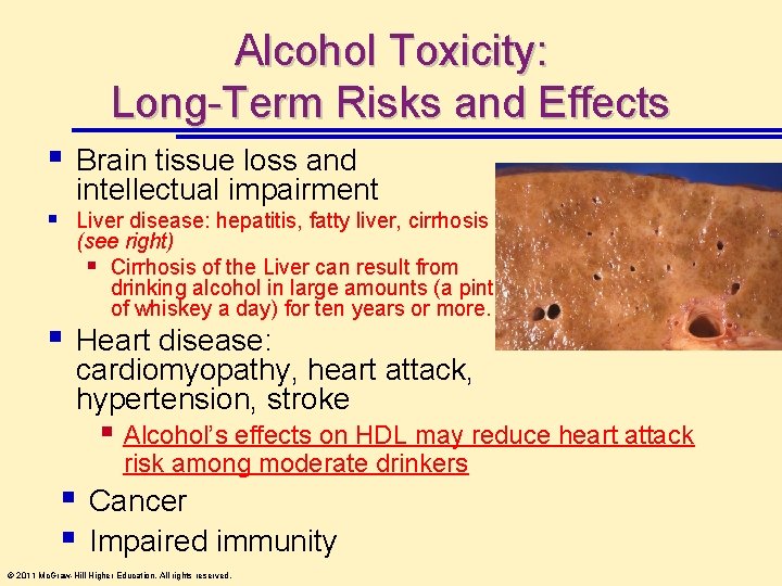 Alcohol Toxicity: Long-Term Risks and Effects § § § Brain tissue loss and intellectual