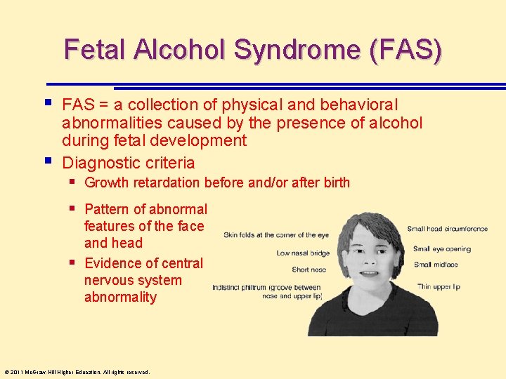 Fetal Alcohol Syndrome (FAS) § § FAS = a collection of physical and behavioral
