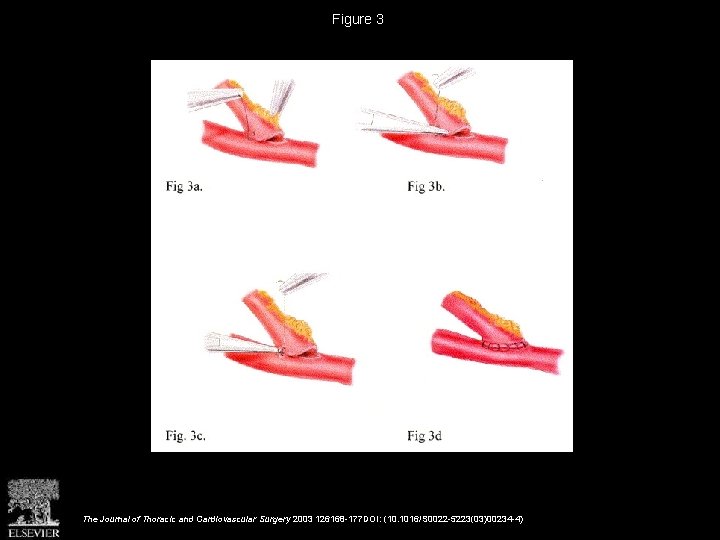 Figure 3 The Journal of Thoracic and Cardiovascular Surgery 2003 126168 -177 DOI: (10.