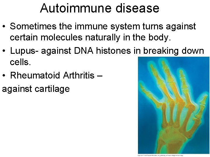 Autoimmune disease • Sometimes the immune system turns against certain molecules naturally in the