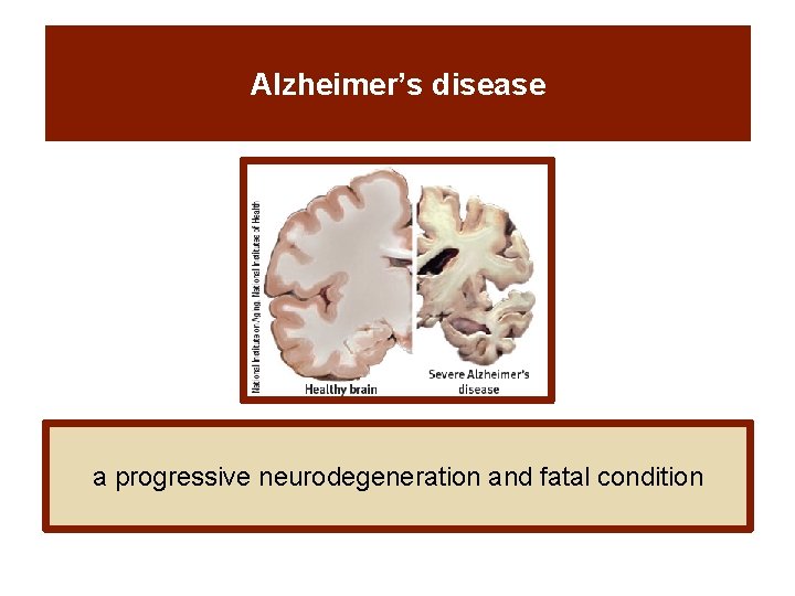 Alzheimer’s disease a progressive neurodegeneration and fatal condition 