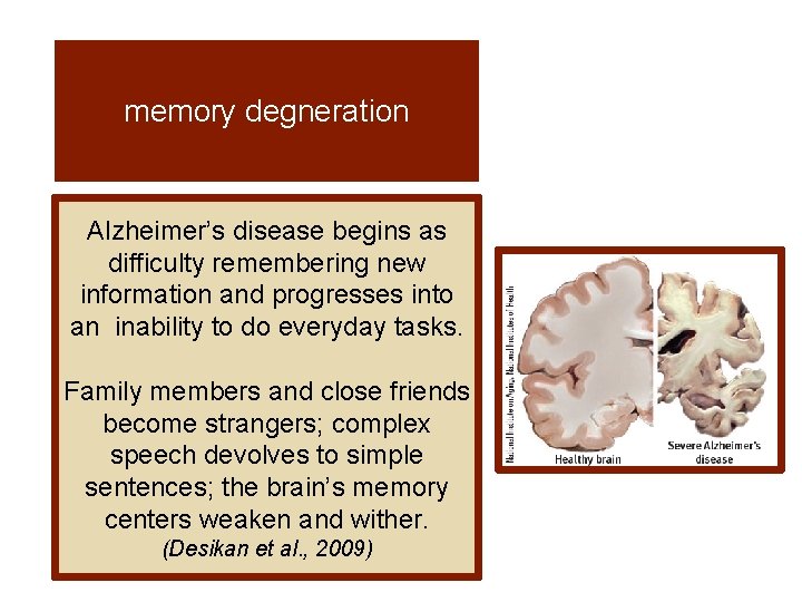 memory degneration Alzheimer’s disease begins as difficulty remembering new information and progresses into an