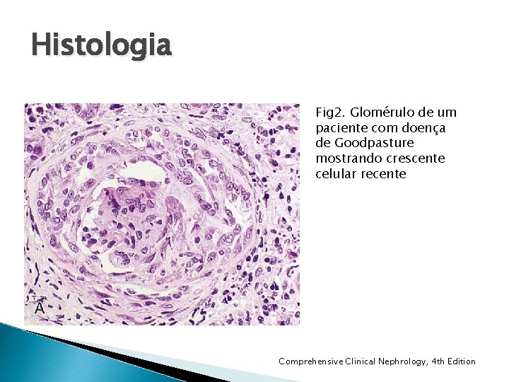 Histologia Fig 2. Glomérulo de um paciente com doença de Goodpasture mostrando crescente celular Histologia Fig 2. Glomérulo de um paciente com doença de Goodpasture mostrando crescente celular