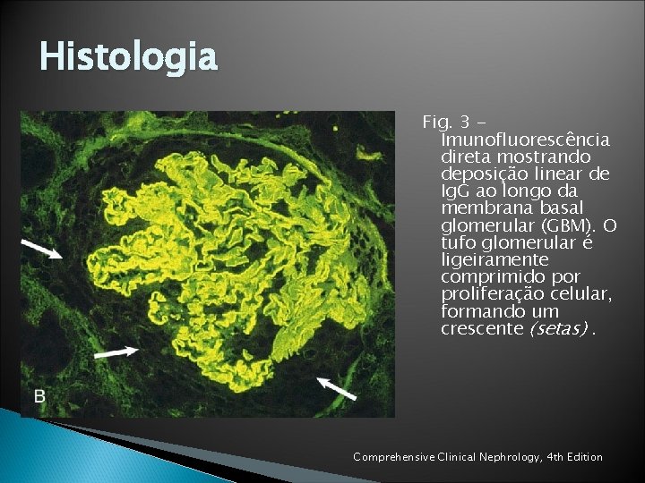 Histologia Fig. 3 Imunofluorescência direta mostrando deposição linear de Ig. G ao longo da Histologia Fig. 3 Imunofluorescência direta mostrando deposição linear de Ig. G ao longo da
