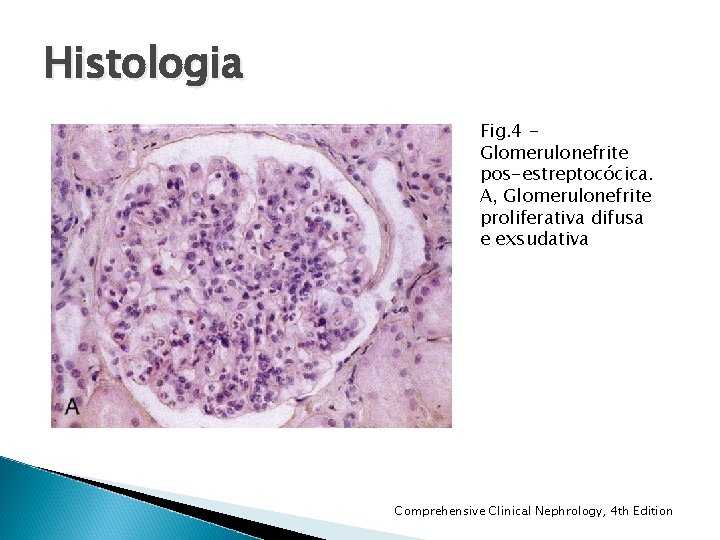 Histologia Fig. 4 Glomerulonefrite pos-estreptocócica. A, Glomerulonefrite proliferativa difusa e exsudativa Comprehensive Clinical Nephrology, Histologia Fig. 4 Glomerulonefrite pos-estreptocócica. A, Glomerulonefrite proliferativa difusa e exsudativa Comprehensive Clinical Nephrology,