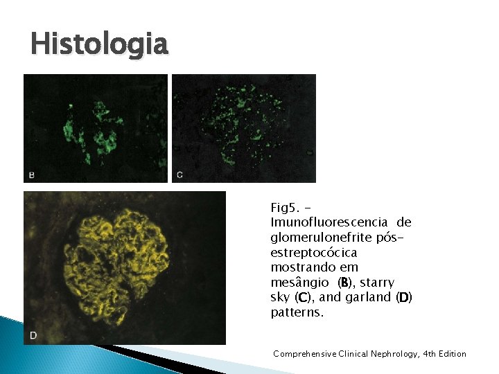 Histologia Fig 5. Imunofluorescencia de glomerulonefrite pósestreptocócica mostrando em mesângio (B), starry sky (C), Histologia Fig 5. Imunofluorescencia de glomerulonefrite pósestreptocócica mostrando em mesângio (B), starry sky (C),