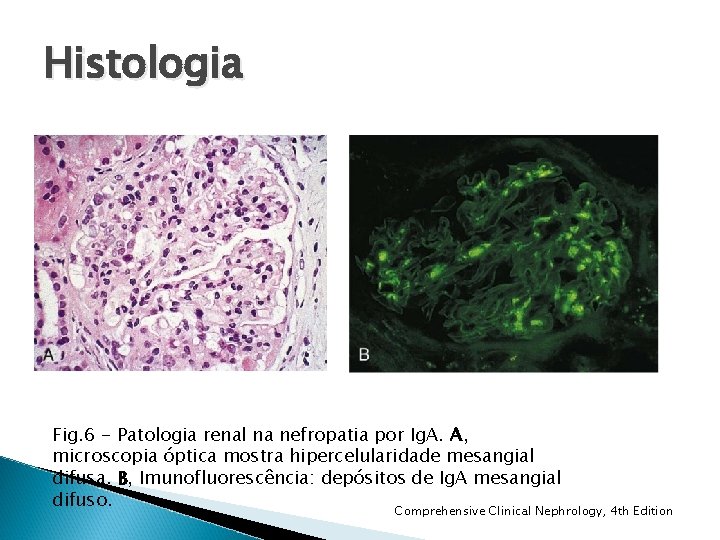 Histologia Fig. 6 - Patologia renal na nefropatia por Ig. A. A, microscopia óptica Histologia Fig. 6 - Patologia renal na nefropatia por Ig. A. A, microscopia óptica