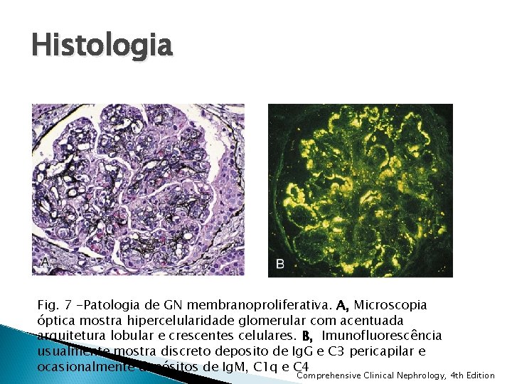 Histologia Fig. 7 -Patologia de GN membranoproliferativa. A, Microscopia óptica mostra hipercelularidade glomerular com Histologia Fig. 7 -Patologia de GN membranoproliferativa. A, Microscopia óptica mostra hipercelularidade glomerular com