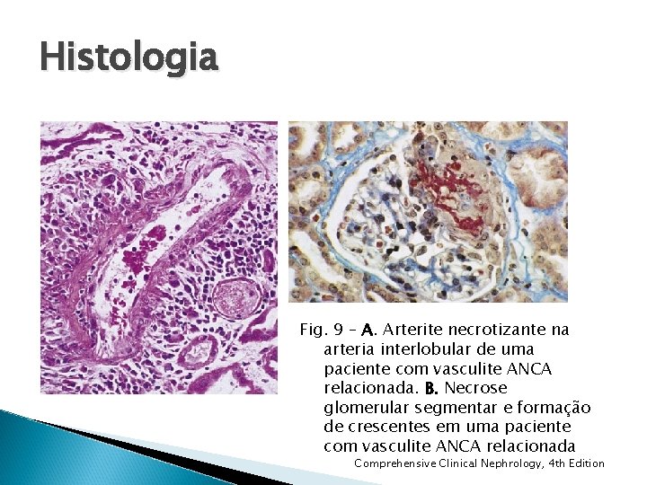 Histologia Fig. 9 – A. Arterite necrotizante na arteria interlobular de uma paciente com Histologia Fig. 9 – A. Arterite necrotizante na arteria interlobular de uma paciente com