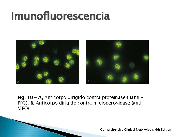 Imunofluorescencia Fig. 10 - A, Anticorpo dirigido contra proteinase 3 (anti – PR 3). Imunofluorescencia Fig. 10 - A, Anticorpo dirigido contra proteinase 3 (anti – PR 3).