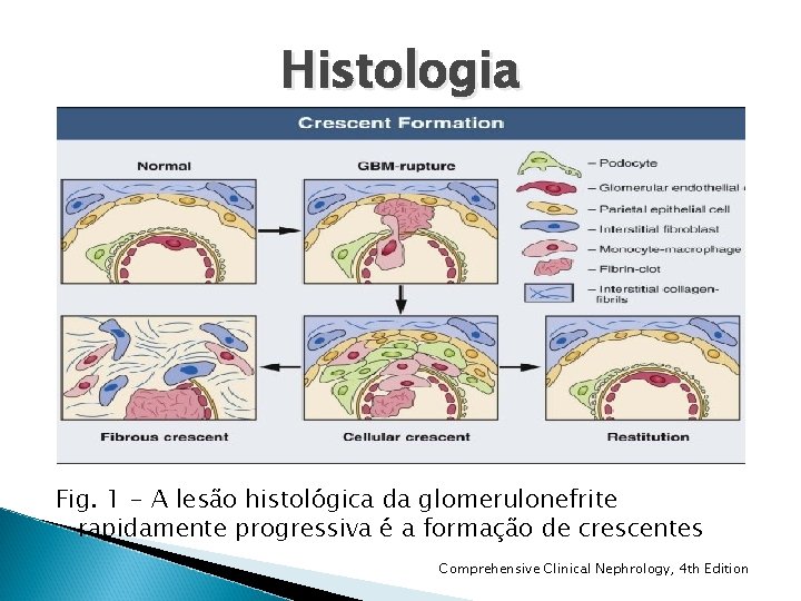 Histologia Fig. 1 - A lesão histológica da glomerulonefrite rapidamente progressiva é a formação Histologia Fig. 1 - A lesão histológica da glomerulonefrite rapidamente progressiva é a formação