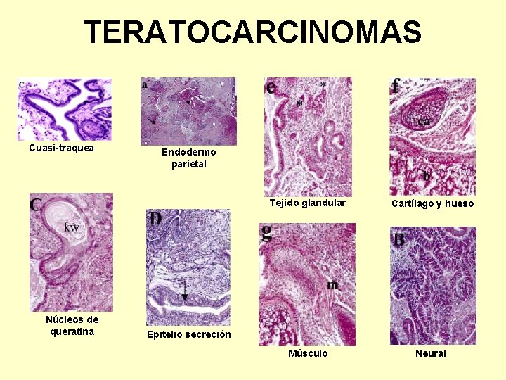 TERATOCARCINOMAS Cuasi-traquea Núcleos de queratina Endodermo parietal Tejido glandular Cartílago y hueso Músculo Neural