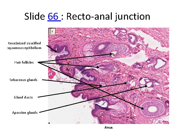 Slide 66 : Recto‐anal junction Keratinized stratified squamous epithelium Hair follicles Sebaceous glands Gland