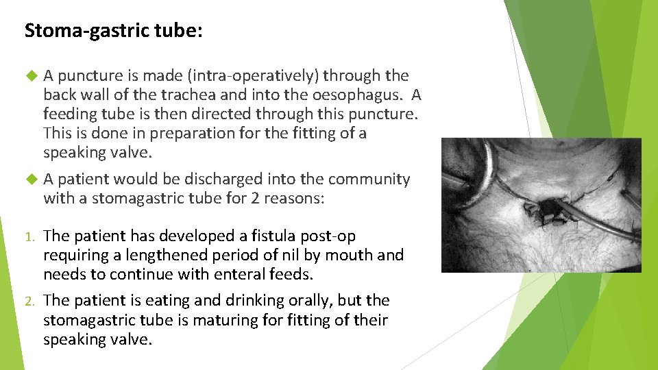 Stoma-gastric tube: A puncture is made (intra-operatively) through the back wall of the trachea