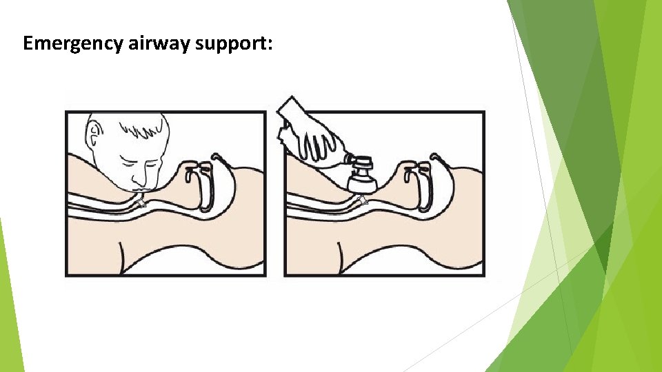 Emergency airway support: 