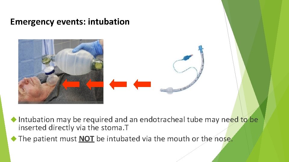 Emergency events: intubation Intubation may be required an endotracheal tube may need to be