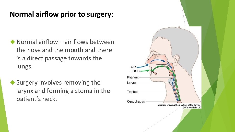 Normal airflow prior to surgery: Normal airflow – air flows between the nose and