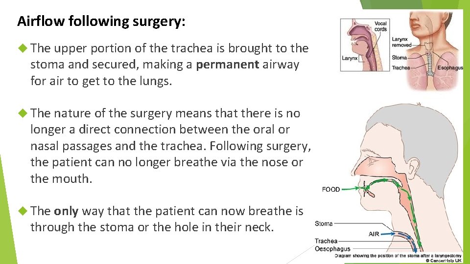 Airflow following surgery: The upper portion of the trachea is brought to the stoma