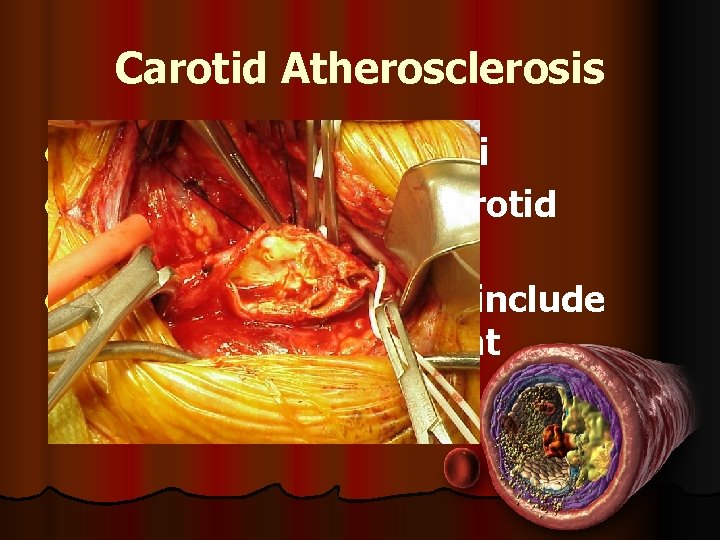 Carotid Atherosclerosis l Symptoms from emboli l Standard of Care is Carotid Endarterectomy l