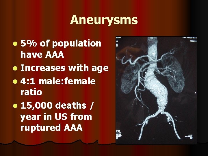 Aneurysms l 5% of population have AAA l Increases with age l 4: 1