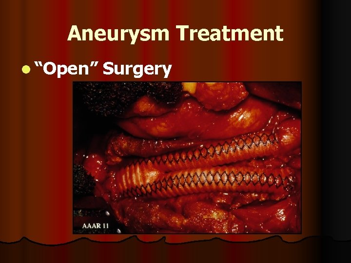 Aneurysm Treatment l “Open” Surgery 