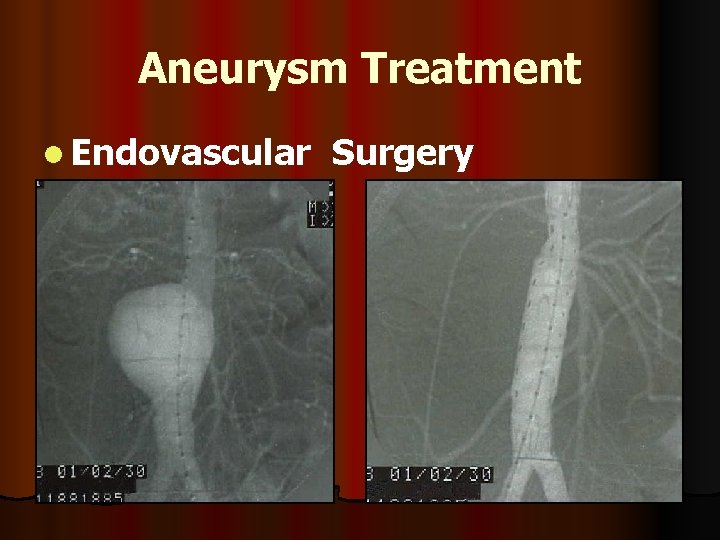 Aneurysm Treatment l Endovascular Surgery 