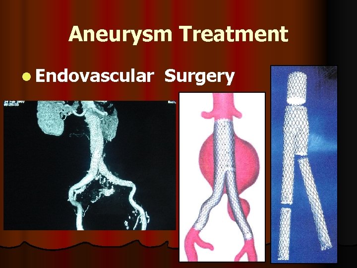 Aneurysm Treatment l Endovascular Surgery 