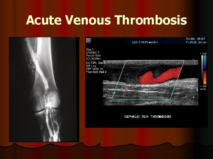 Acute Venous Thrombosis 