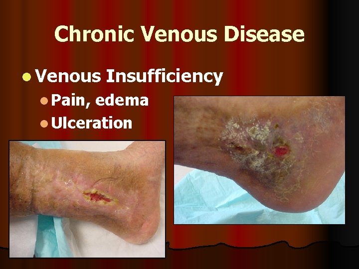 Chronic Venous Disease l Venous l Pain, Insufficiency edema l Ulceration 