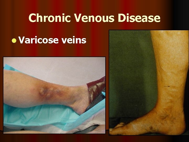 Chronic Venous Disease l Varicose veins 