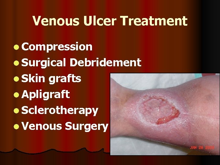 Venous Ulcer Treatment l Compression l Surgical Debridement l Skin grafts l Apligraft l