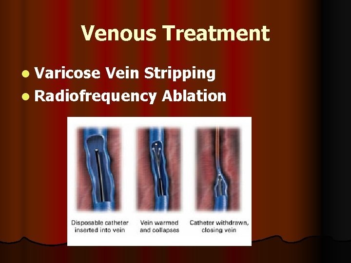 Venous Treatment l Varicose Vein Stripping l Radiofrequency Ablation 