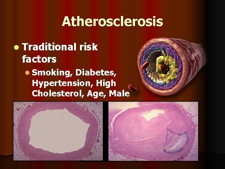Atherosclerosis l Traditional factors risk l Smoking, Diabetes, Hypertension, High Cholesterol, Age, Male l
