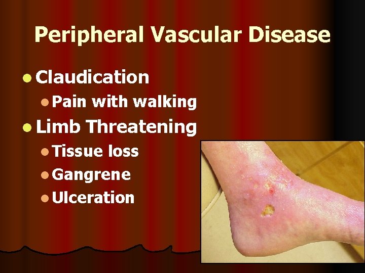 Peripheral Vascular Disease l Claudication l Pain l Limb with walking Threatening l Tissue