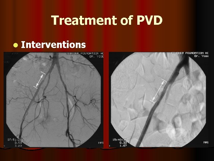 Treatment of PVD l Interventions 