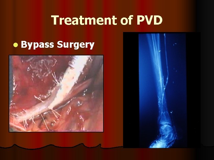 Treatment of PVD l Bypass Surgery 