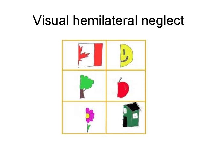 Visual hemilateral neglect 