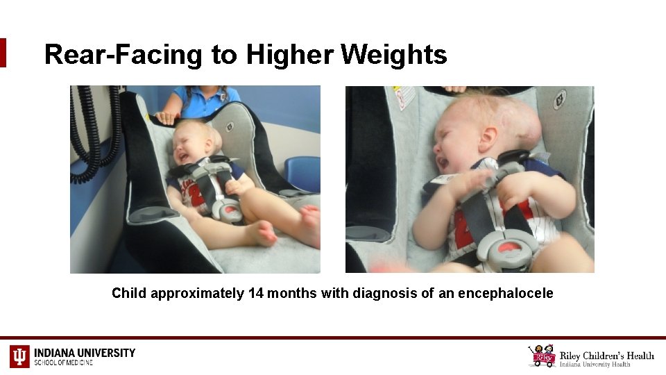 Rear-Facing to Higher Weights Child approximately 14 months with diagnosis of an encephalocele 