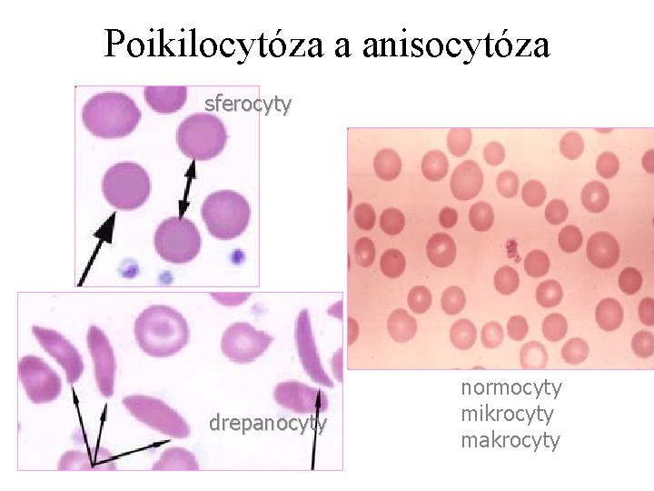 Poikilocytóza a anisocytóza sferocyty drepanocyty normocyty mikrocyty makrocyty 