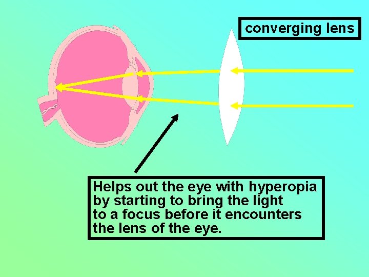 converging lens Helps out the eye with hyperopia by starting to bring the light