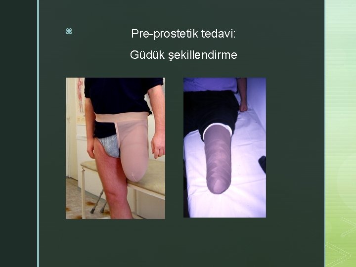 z Pre-prostetik tedavi: Güdük şekillendirme 