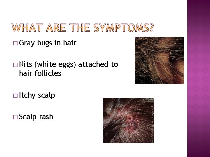 � Gray bugs in hair � Nits (white eggs) attached to hair follicles �