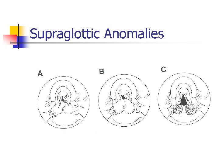 Supraglottic Anomalies 