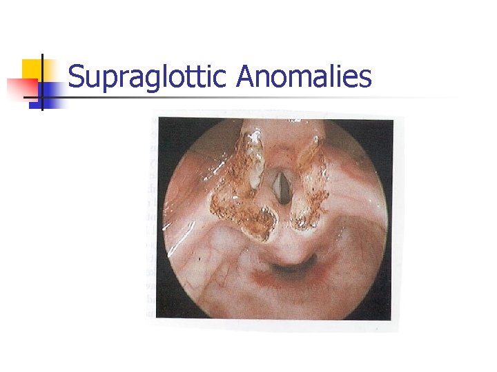 Supraglottic Anomalies 