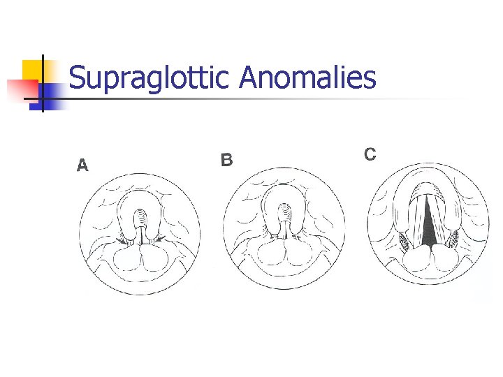 Supraglottic Anomalies 