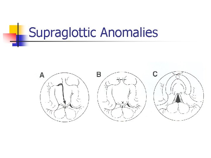 Supraglottic Anomalies 