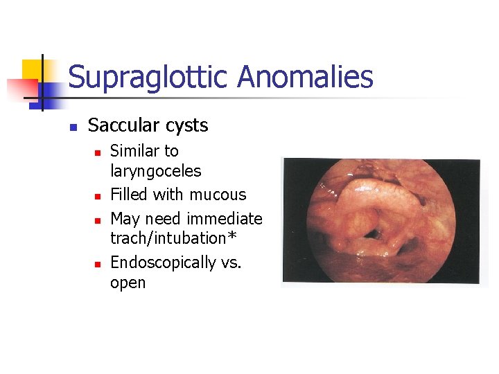 Supraglottic Anomalies n Saccular cysts n n Similar to laryngoceles Filled with mucous May