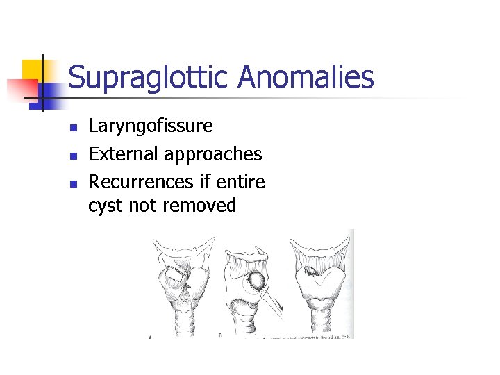 Supraglottic Anomalies n n n Laryngofissure External approaches Recurrences if entire cyst not removed