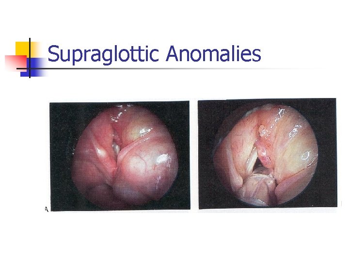 Supraglottic Anomalies 